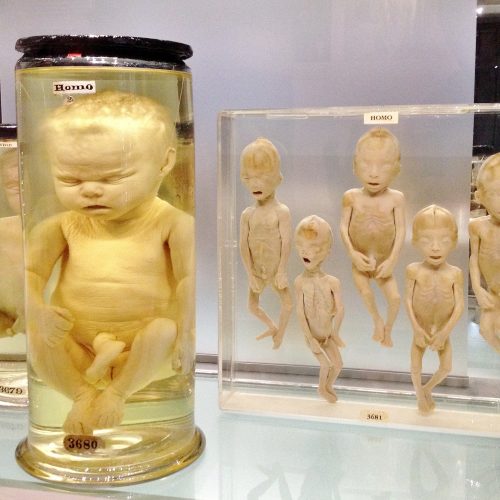Foetuses inside the Hunterian Museum in London